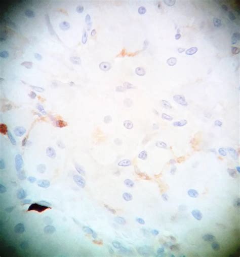 Pathology Outlines - Congenital epulis of newborn