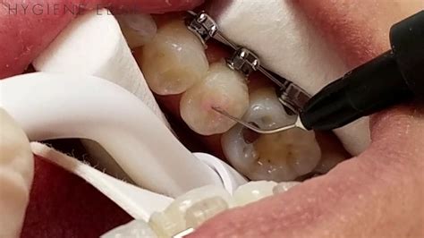 Dental Sealants Procedure