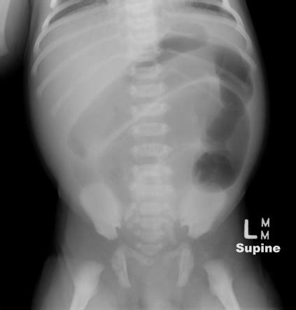 Hirschsprung disease | Radiology Reference Article | Radiopaedia.org