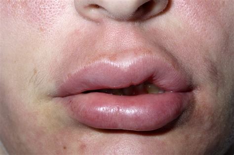 ANGIOEDEMA – Dermatology Conditions and Treatments