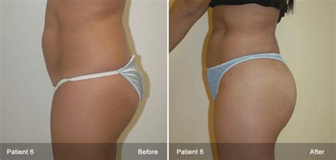 Brazilian butt lift before and after - advisorgasw