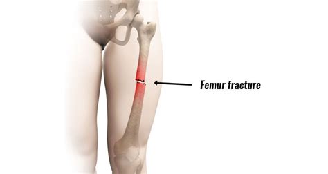 Femur Fracture (Acute) - Broken Thigh Bone Causes and Treatment