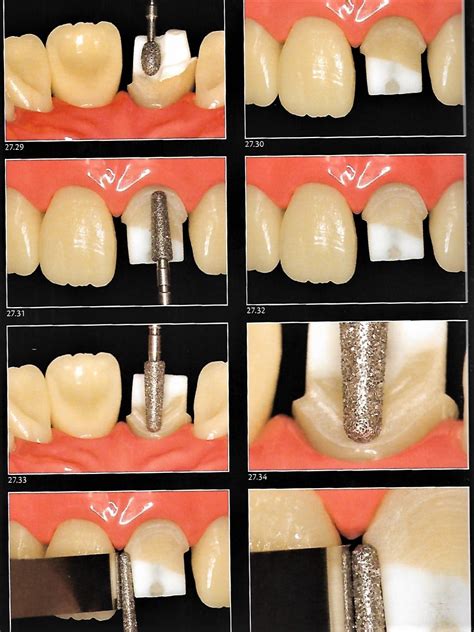 Anterior Crown Preparation | Dental Esthetics