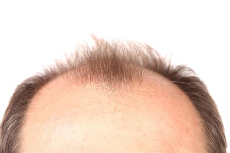 Female Pattern Baldness Receding Hairline