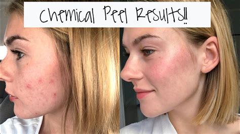 chemical peel near me reviews - Bernarda Higginbotham