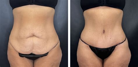 Combining Forces: Exploring The Duo Of Tummy Tuck And Liposuction ...