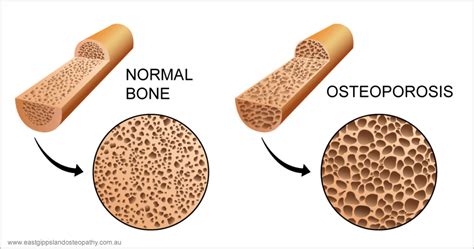 Pathophysiology Of Osteoporosis Diagram