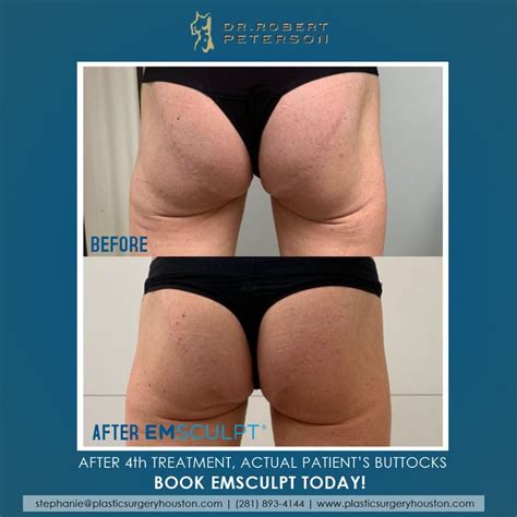 EMSCULPT before & after images after four treatments.