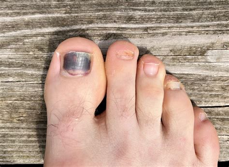 Black Toenail: Causes, Treatment, and Prevention Tips - Feet First Clinic