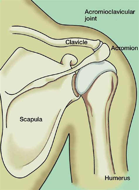 How To Fix Ac Joint Separation - Mansfield Sperve