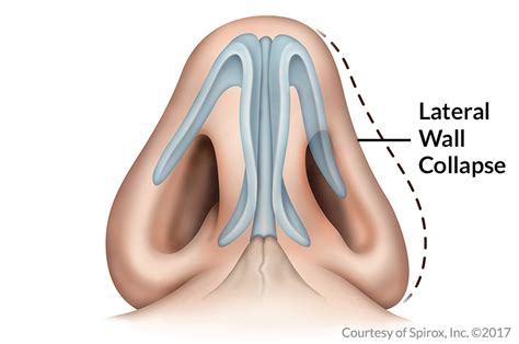 Nasal Valve Collapse | Latera Implant San Antonio - Dr. Jose Barrera ...