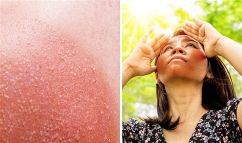 How to avoid prickly heat or heat rash - the 5 tips - TechiAzi