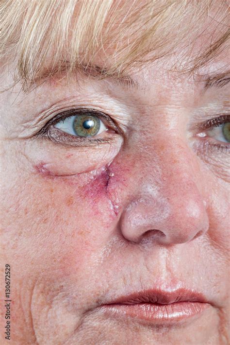 Mature woman with scar and spitting suture one week after Mohs surgery for Basal Cell Carcinoma ...