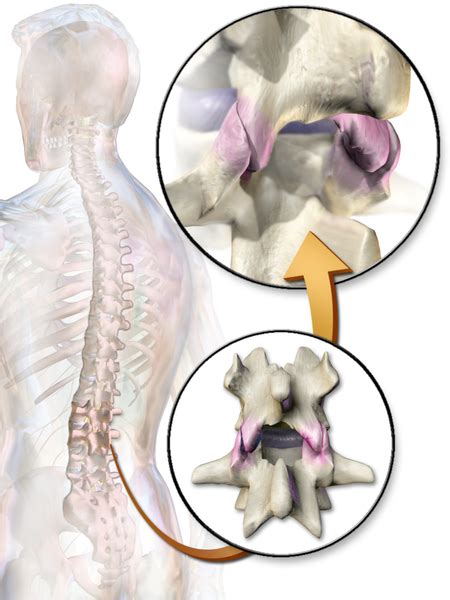 Facet Joint Syndrome - Physiopedia