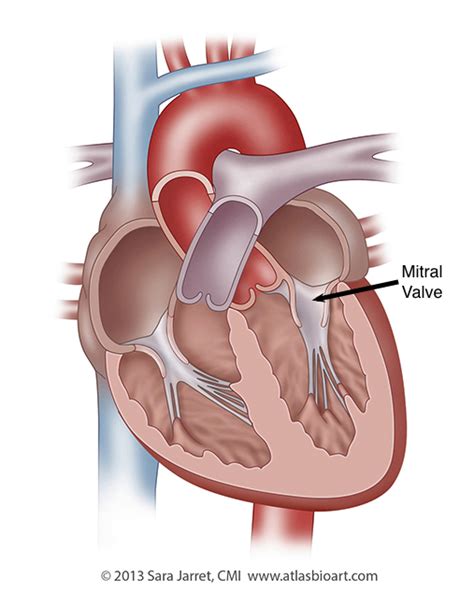 Mitral Valve Surgeon | Mitral Valve Surgeon