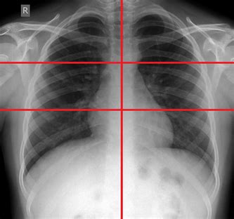 The Role of Chest X-Ray in Monitoring Lung Changes among COVID-19 Patients in Gaza Strip