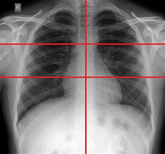 The Role of Chest X-Ray in Monitoring Lung Changes among COVID-19 Patients in Gaza Strip