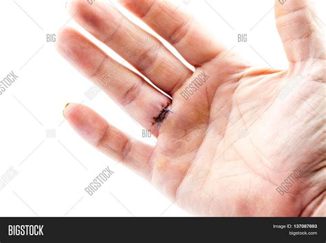 After Removal Cyst Finger Hand This Image & Photo | Bigstock