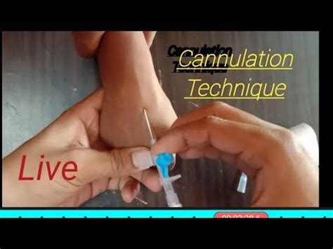 Cannulation insertion technique || cannula Procedure || intravenous cannula insertion - YouTube ...