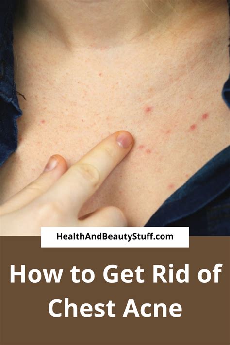 How to Get Rid of Chest Acne | Chest acne, Get rid of chest acne, How ...