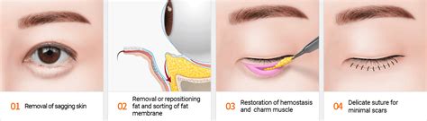 Eye Bag Removal Surgery in Singapore | Dream Plastic Surgery