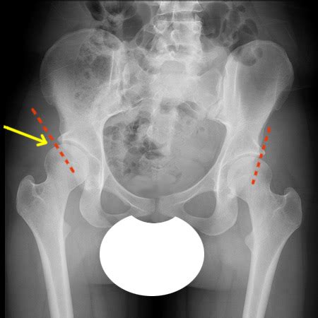 Congenital Hip Dysplasia Symptoms & Treatments | Orthopedics