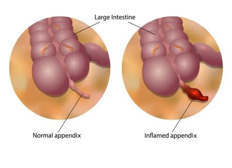 Perforated Appendix