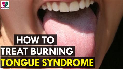 How to Treat Burning Tongue Syndrome - Health Sutra - YouTube