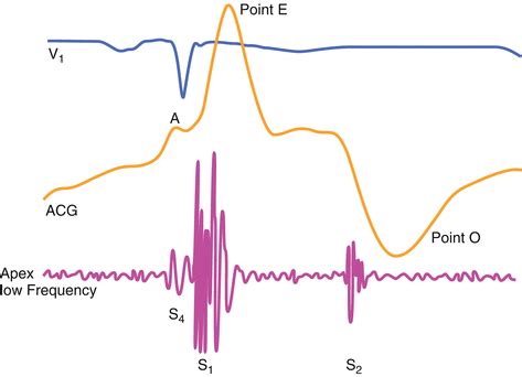 The S4 Gallop | Thoracic Key