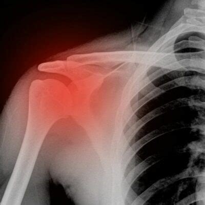 Shoulder Fracture | Shoulder Specialist | South Windsor, Enfield, Glastonbury CT