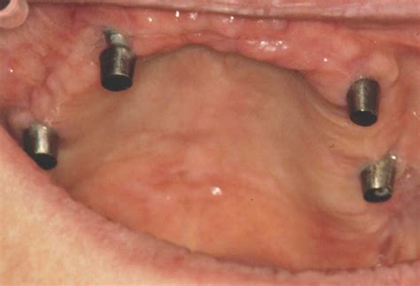 Dental subperiosteal implant – THE IMPLANT REGISTER