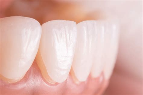 EMAX Laminate Veneers - Implant Treatment in Turkey - Implant Prices, Treatment Packages ...