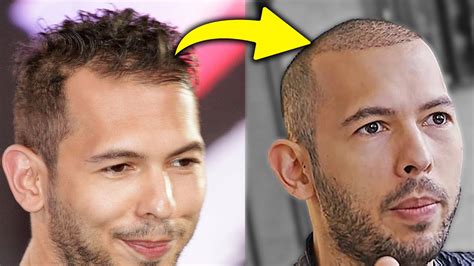 I Cracked Andrew Tate's Hair Transplant Secret! - YouTube