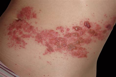 Dermatomes Face Shingles