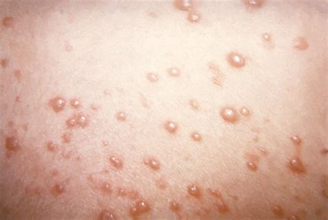 Pakistan chickenpox update: Two additional deaths reported in ...