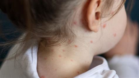 Measles alert for Sydney and Canberra after international traveller returns with disease | The ...