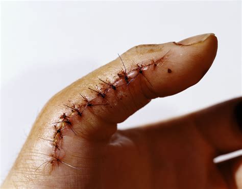 Do You Need to Get Stitches for That?