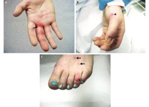 Disseminated Gonococcal Infection: Causes and Symptoms