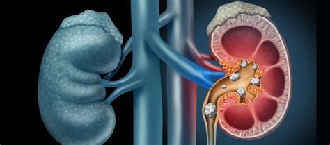 Thiola EC Approved for Treatment of Cystinuria - Renal and Urology News