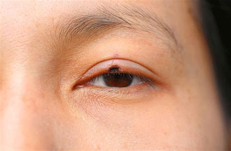 Eyelid Skin Cancers Eyelid Bcc Mr David Cheung Eyelid - vrogue.co