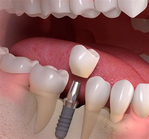 Single Tooth Implant | Single Teeth Implant