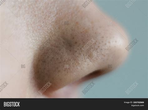 Black Dots On Nose. Image & Photo (Free Trial) | Bigstock