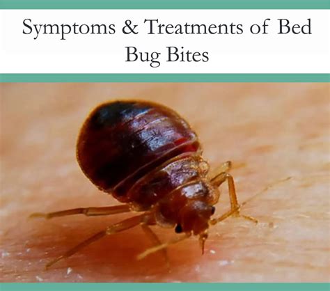 Bed Bug Bites - Symptoms and Treatments - The Pest Advice