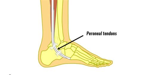 Peroneal Tendon Dislocation - Symptoms, Causes, Treatment & Rehab