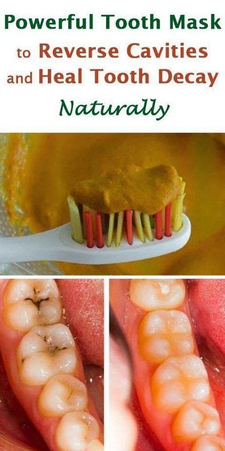 Powerful Tooth Mask to Reverse Cavities and Heal Tooth Decay Naturally #GoodOralHealth | Teeth ...