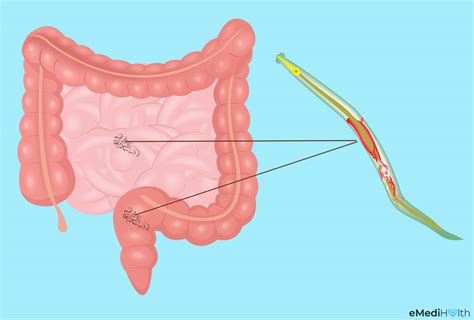 Pinworms In Humans Around Anus