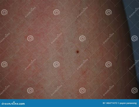 Skin is Red Rash Caused by Allergies. Stock Photo - Image of healthcare ...