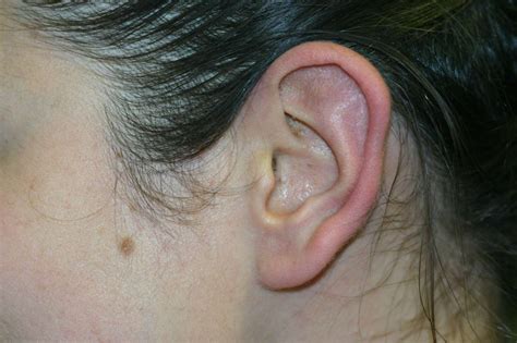 Sticking out Ears & Lobes - no-surgery and surgery options for all ages