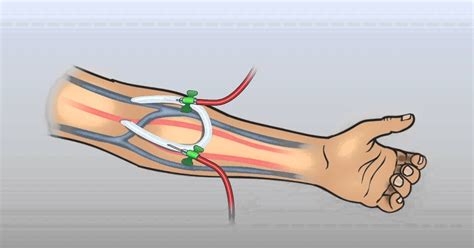 MEDICINE: The arteriovenous (AV) graft part 1