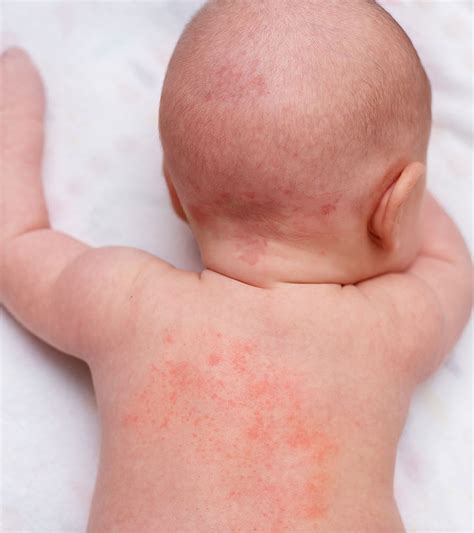 Baby Heat Rash: What Is It, Causes, And How To Prevent It